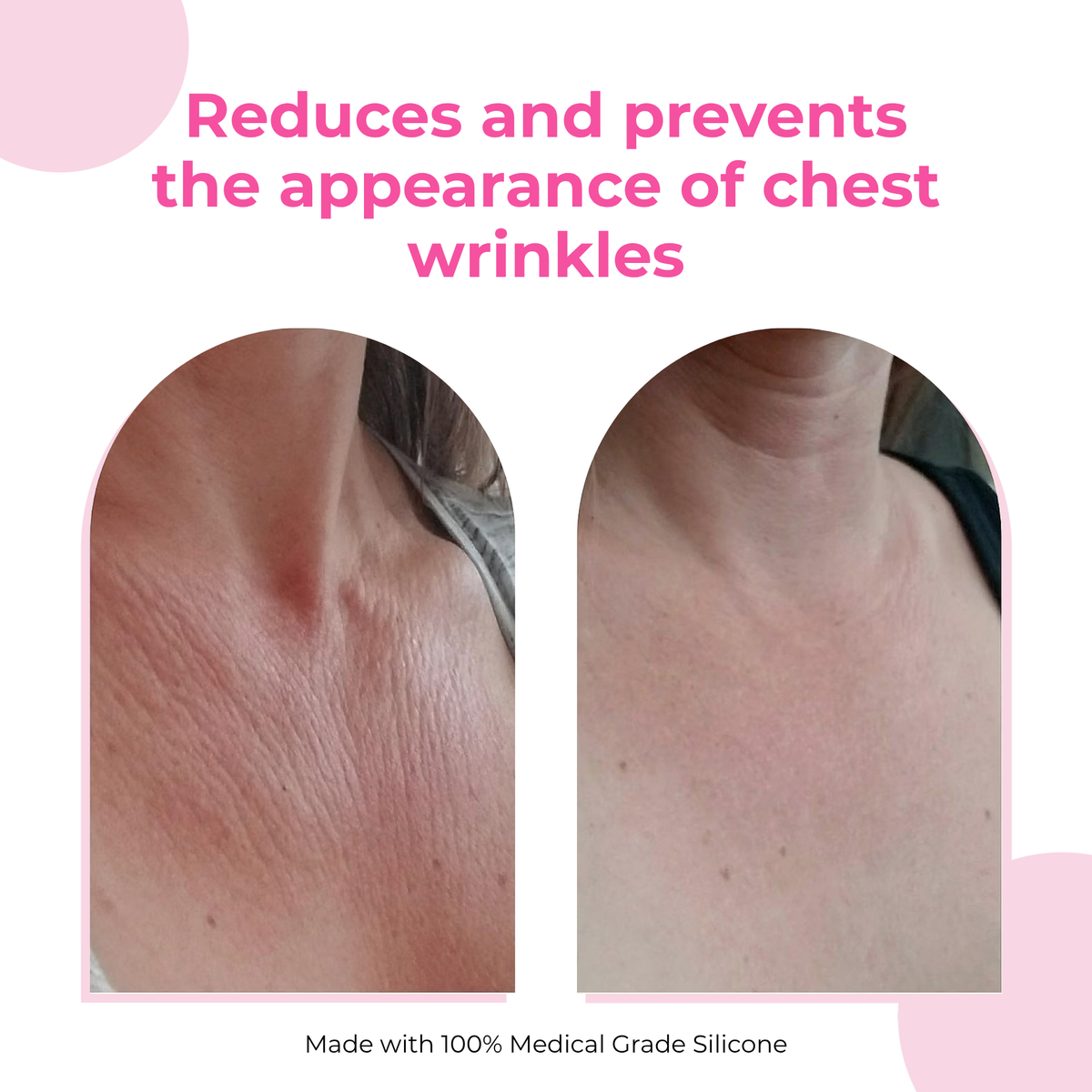 Queen Royal Chest Patches Wrinkle Smoothing (2 Pcs)